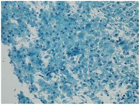 Luxol Fast Blue Stain Shows Areas Of Demyelination With Relative