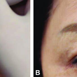 (A) Detection of the supratrochlear artery. (B) Marking the location of ...