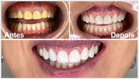 Lente Contato Dental Antes E Depois Kb Implart