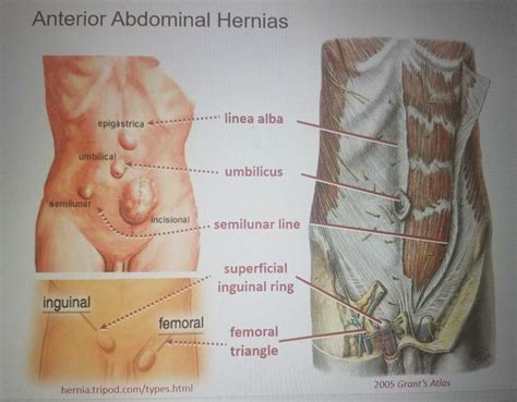 Anterior Abdominal Hernias Diagram Quizlet Free Hot Nude Porn Pic