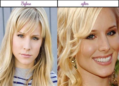 Amazing Plastic Surgery Pictures Of Kristen Bell Immedi Flickr