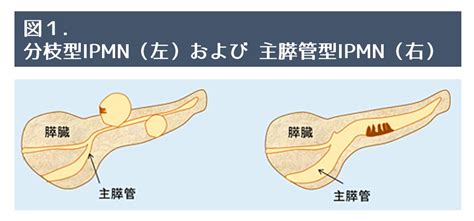 膵管内乳頭粘液性腫瘍（IPMN）：膵臓の病気と治療｜肝胆膵・移植班－慶應義塾大学病院 一般・消化器外科