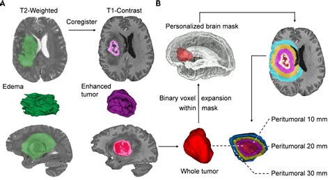 Frontiers Differentiation Of Malignant Brain Tumor Types Using