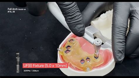 DIOnavi FullArch Hands On Implant Part YouTube