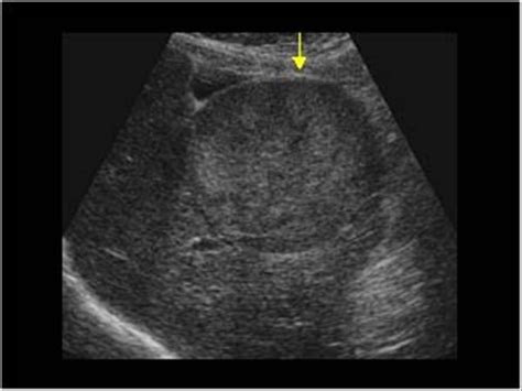 Abdomen and retroperitoneum | 1.1 Liver : Case 1.1.7 Hepatocellular ...