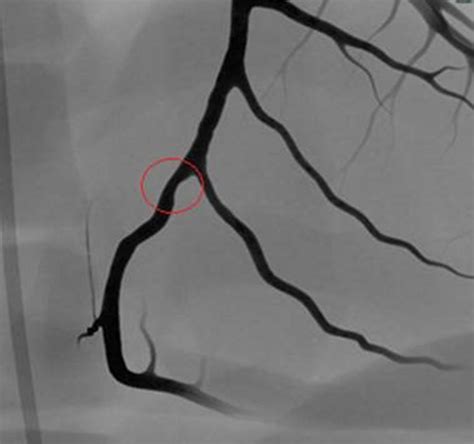 Coronary Bifurcation Module Surgical Science