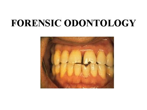 FORENSIC ODONTOLOGY History 66 A D Nero the