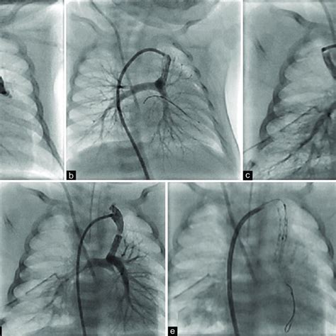 Duct Dependent Stenting A Primary Injection And Site Of Arterial