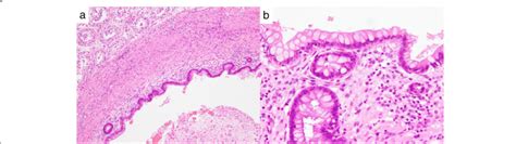 Hematoxylin And Eosin Staining In A Low Power And B High Power Field