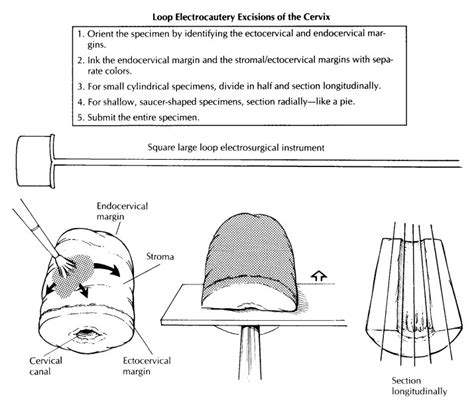 Uterus Cervix And Vagina Surgical Pathology Dissection