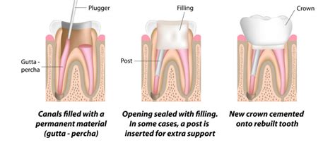 Root Canal Treatment Services Dentists In Campsie Burwood