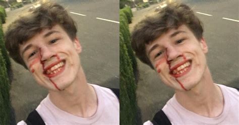 Chico gay comparte una selfie sonriendo y ensangrentado tras ataque homofóbico y se hace viral
