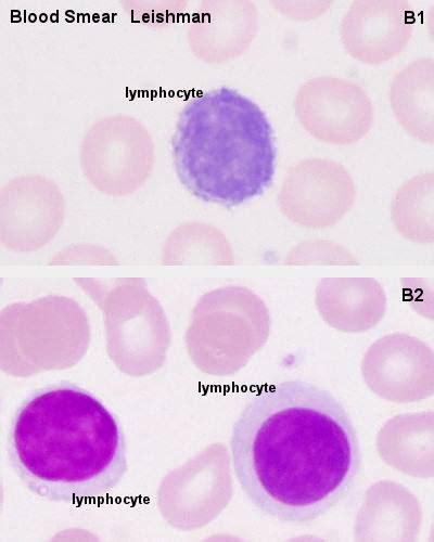 Small vs Large lymphocytes | Medical Laboratories