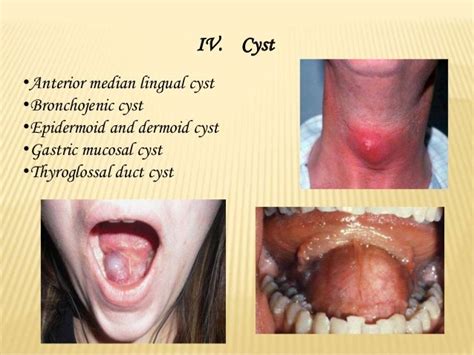 Diseases of tongue