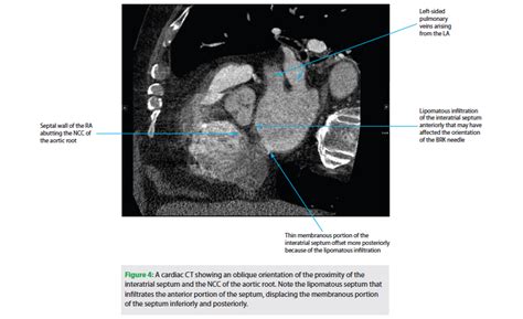 managing  aortic root perforation  transseptal puncture
