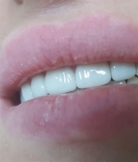Купить Виниры съемные Snap On Smile для зубов двойные верх и низ на ...