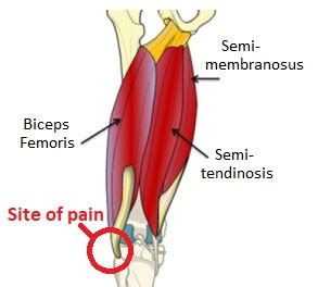 Lateral Knee Pain: Causes & Treatment - Knee Pain Explained