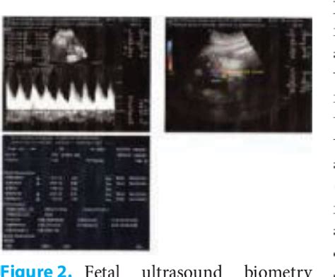 Figure 2 From Single Umbilical Artery SUA Prenatal Sonography