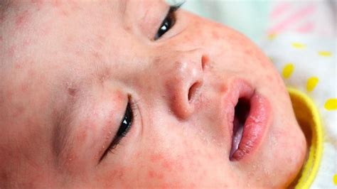 Measles Cases Hit Record High In Europe Bbc News