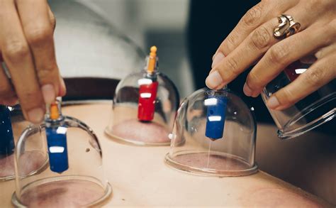 Dry And Wet Cupping Therapy