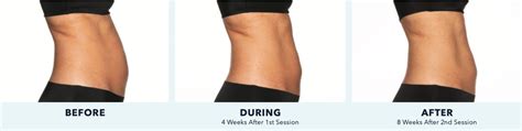 CoolSculpting Elite - The Medical Skin Clinic