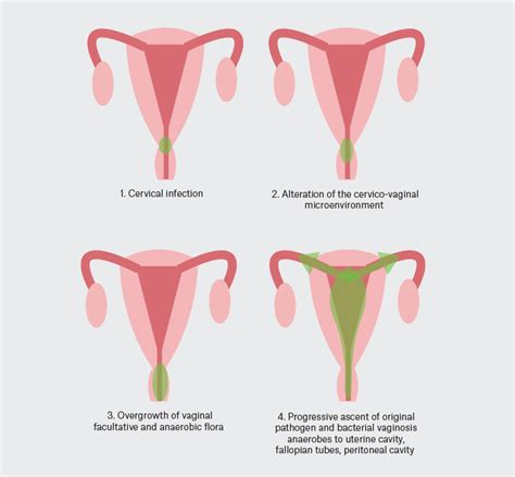 Racgp Pelvic Inflammatory Disease And Infertility