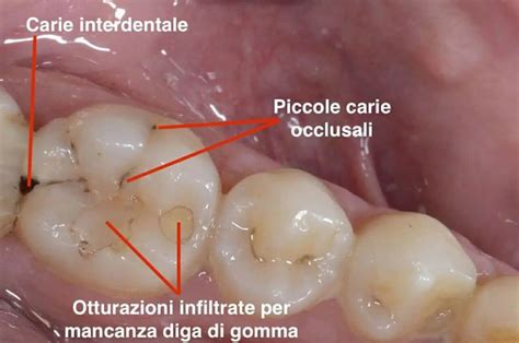 Cosa Bisogna Fare In Caso Di Denti Cariati Cause Sintomi E Cure