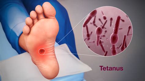 Tetanus Symptom Orsaker Och Behandling Medicinsk