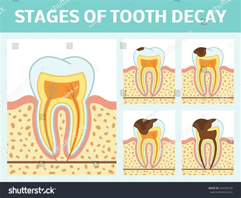 Stages Of Tooth Decay Over Royalty Free Licensable Stock Vectors