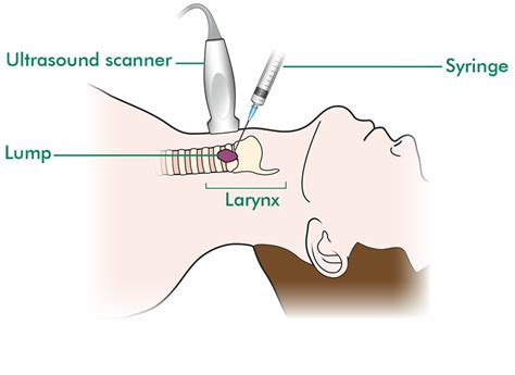 Fna For Laryngeal Cancer Macmillan Cancer Support