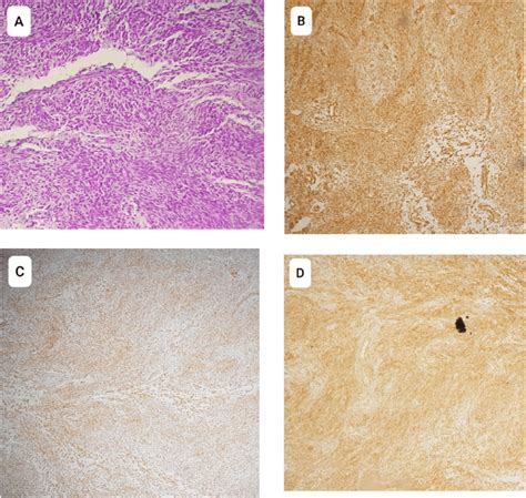 Microscopic Examination And Immunohistochemical Study A Hematoxylin