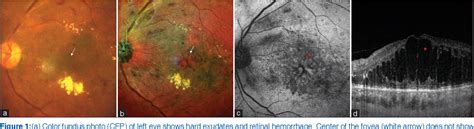 Cystoid Macular Degeneration Semantic Scholar