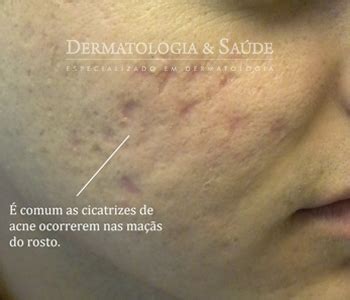 Cicatrizes De Acne