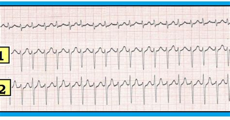 Ecg Interpretation Ecg Interpretation Review Psvt Avnrt Avrt