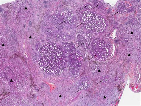 Thyroid Cancer Cells Under Microscope