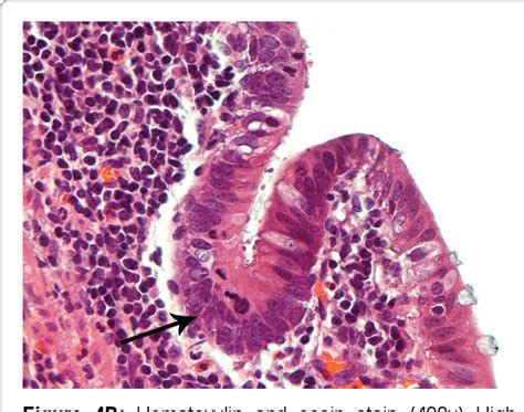 Figure From Minimally Invasive Surgery For Resection Of Appendiceal