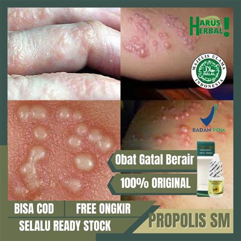 Jual PROPOLIS SM Obat Kulit Gatal Berair Di Jari Obat Bintik Berair