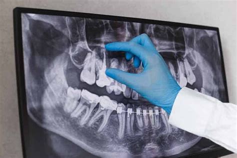 Root Canal Vs Extraction Marmaris Dental Center