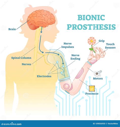 Bionic Prosthesis Isometric Infographic Flat Vector Illustration