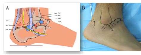 Figure 3 From Safety And Clinical Efficacy Of Double Posterolateral