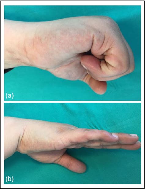 Figure 1 From Flexor Pulley Reconstruction Using A Palmar Fascia Strip A Case Report Semantic