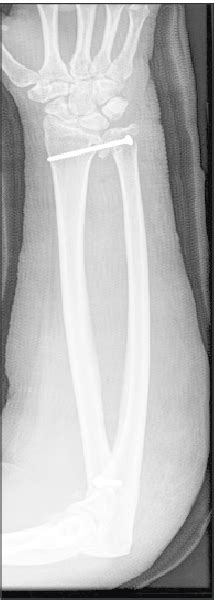 One Bone Forearm With Proximal And Distal Fixation Image Courtesy Of