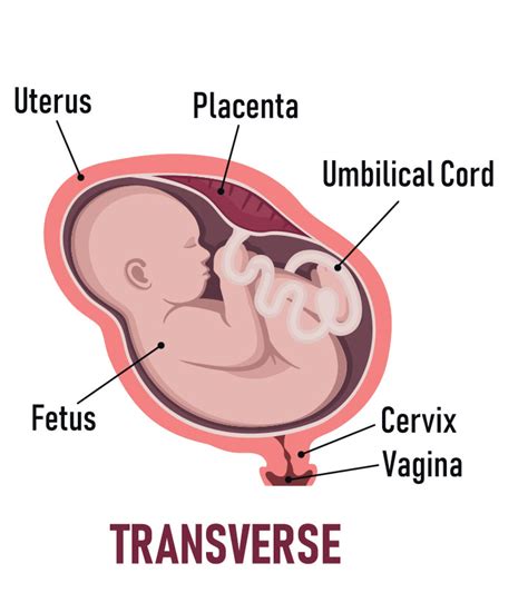 5 Ways To Turn A Baby From Transverse Lie Position