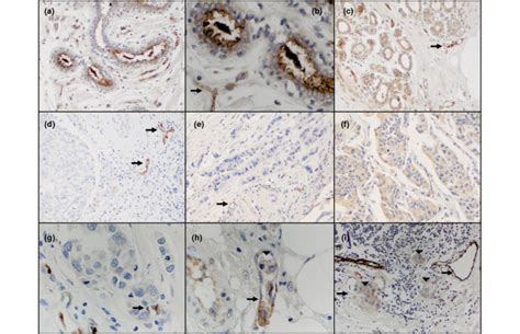 Muc4 Expression In Human Breast Tissue Tissue Microarrays Were