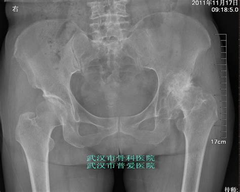 全髋关节置换术髋臼发育不良二 微医挂号网