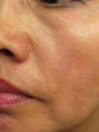 Best Pixel Laser Skin Resurfacing In Dallas Advanced Skin Fitness