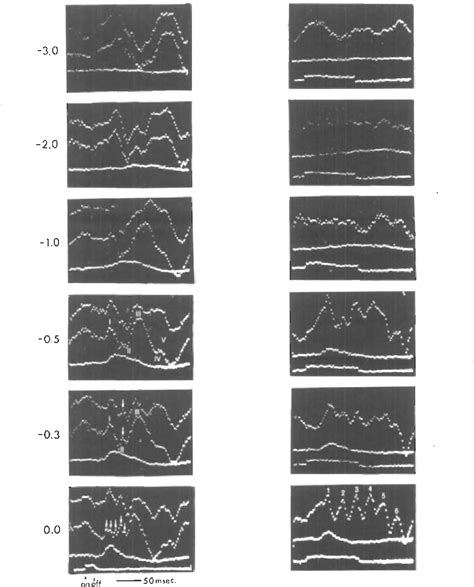 Figure 2 From Simultaneous ERG And VER In Lesions Of The Optic Pathway