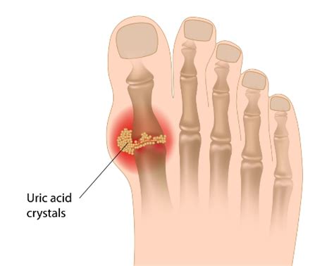 Gout Crystals