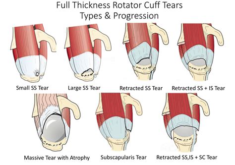 Fig Types Of Tears Cambridge Shoulder