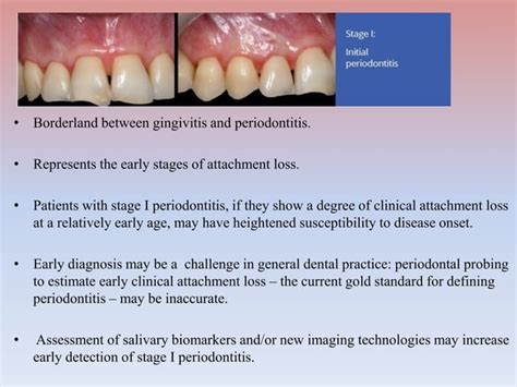 Periodontitis Ppt